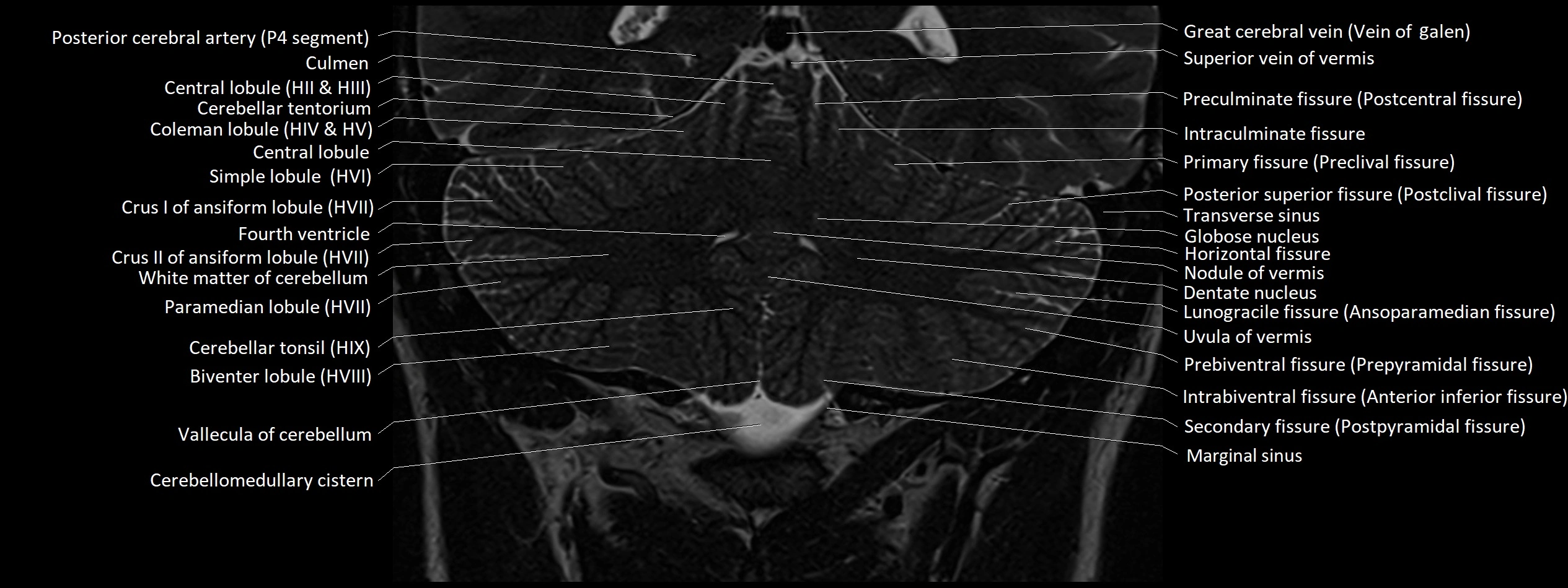 Anatomy of cerebellum coronal cross sectional 3T image 14.webp